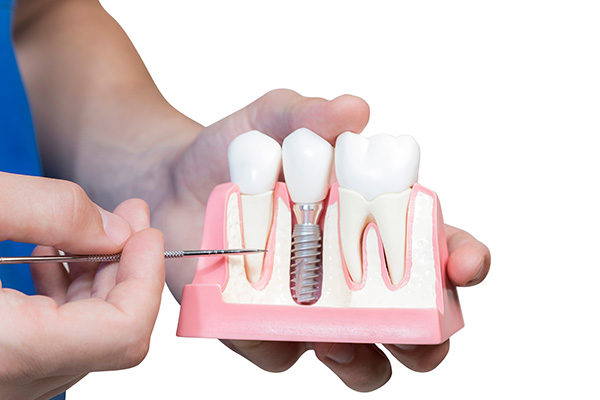 An Implant Dentist Talks About Good Candidates For This Procedure