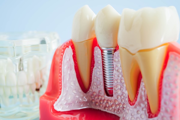 Discover The Lifelong Benefits Of A Dental Implant For Your Oral Health