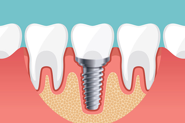 Implant Dentistry Options To Replace a Single Missing Tooth from Davis & Dingle Family Dentistry in Columbia, SC