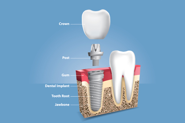 When a Crown Is Placed in the Implant Dentistry Procedure from Davis & Dingle Family Dentistry in Columbia, SC